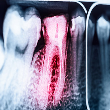 Dental x-ray of root canal treated tooth