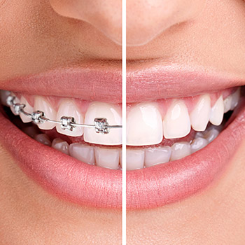 Teeth half with Invisalign half with bracket and wire braces