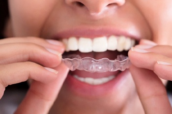 A woman putting in an Invisalign aligner