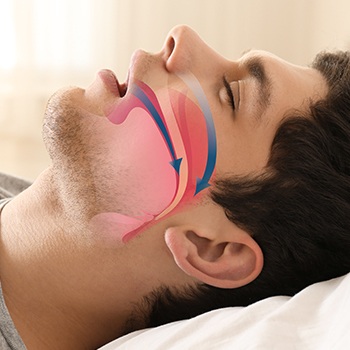 Sleeping man with airway animation over his profile