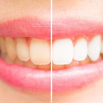 Closeup of teeth half before and half after teeth whitening