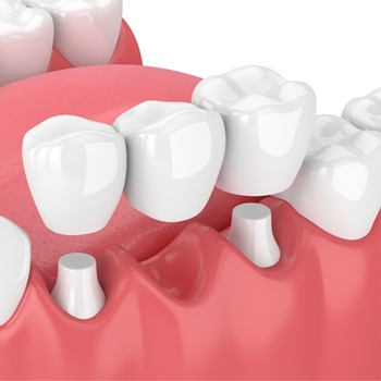 illustration of dental bridge