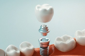 Illustration of crown being attached to one dental implant