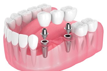 Illustration of dental bridge being attached to dental implants
