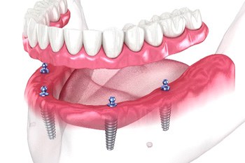 Illustration of denture being attached to dental implants