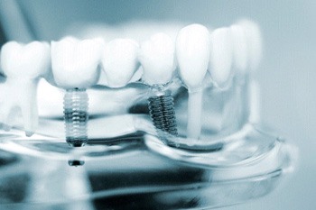 Two dental implants in plastic model of mouth