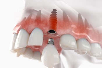 Crown being attached to dental implant in upper jaw