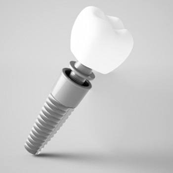 Illustration of crown and dental implant in Portage, IN