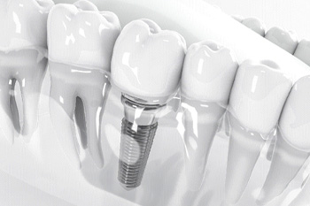 Illustration of dental implant in plastic model of mouth