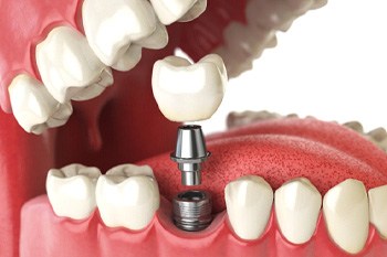 Illustration of crown and abutment being attached to implant post