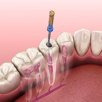 Illustration of root canal treatment being performed on tooth in lower arch