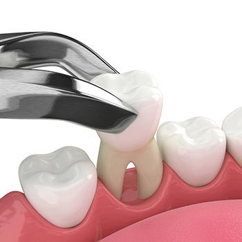 Illustration of forceps being used to extract tooth