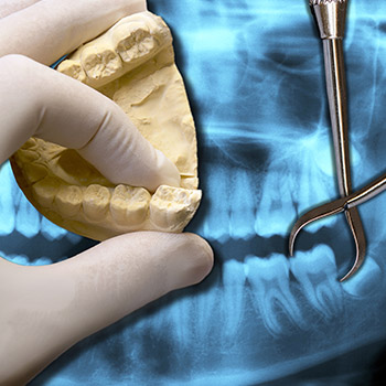 X-ray and models of teeth before extraction