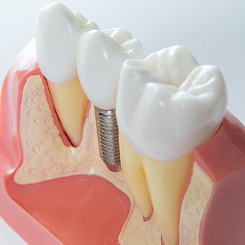 Model of implant retained dental crown