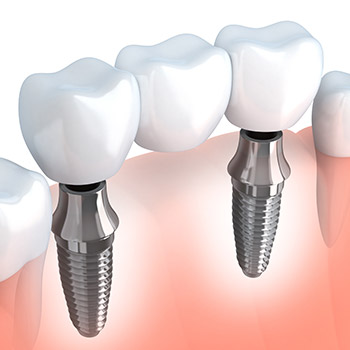 Animation of implant retained bridge