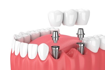 A diagram of an implant-retained bridge.