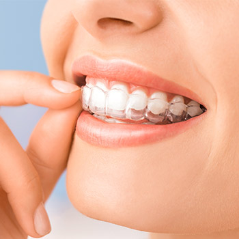 Closeup of patient placing Invisalign tray