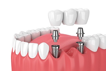 A diagram for implant-retained dental bridges.
