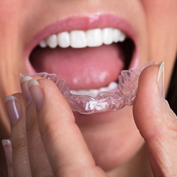 Woman placing tmj appliance