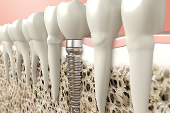 Diagram of a single tooth dental implant in Portage.