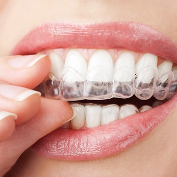 A person putting in their Invisalign aligners