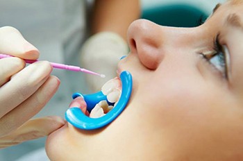 A woman receiving a teeth whitening treatment