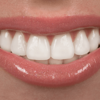 Close up veneer smile