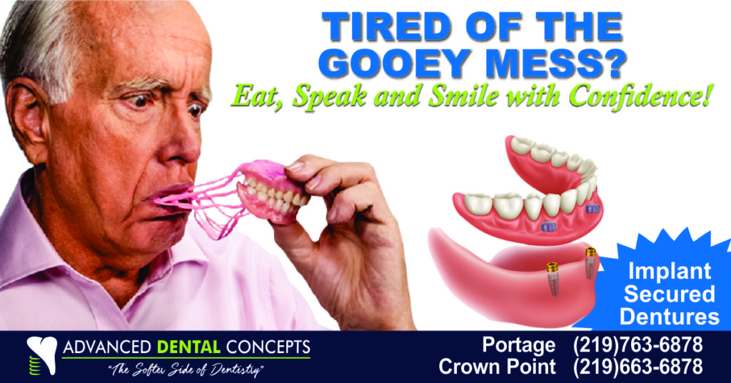 Implant Overdenture