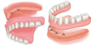 Implant Overdentures