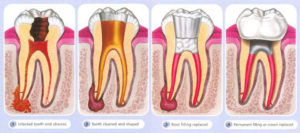 Root Canal Procedure