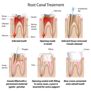 Root Canal Treatment - Steps