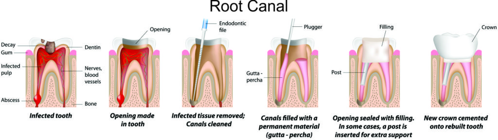 Root Canal Treatment