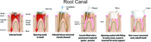 Root Canal Treatment