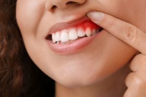 Nose to chin view of a woman with brown hair pulling her gum back with her finger to reveal swollen gums